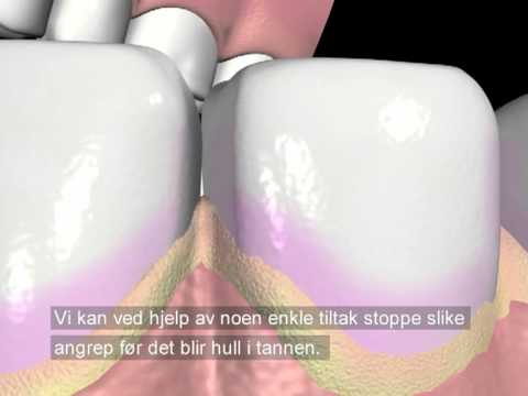 Video: Hva Du Skal Vite Om Fjerning Av Tannstein