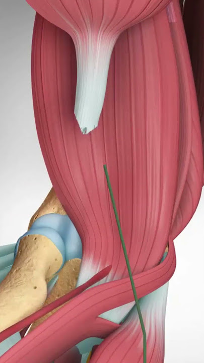 Distal Biceps Tendon Rupture and Repair  #bicepstendon #elbowpain #biceps