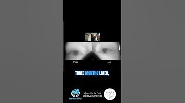 🚨 Not all positional vertigo is BPPV!  This case demonstrates the importance of understanding nysta