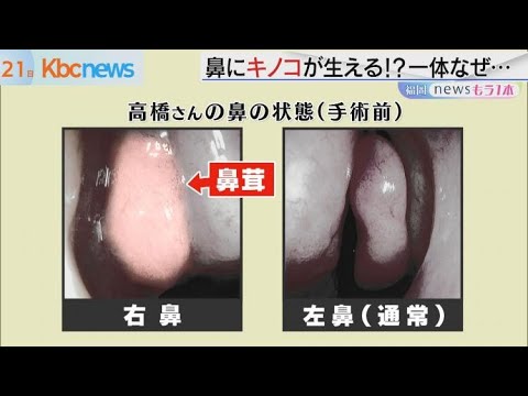 鼻トラブル患者が増加？その原因は…