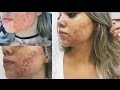 O que aconteceu com o meu rosto? O verdadeiro motivo de tanta acne - Julyanne Nascimento