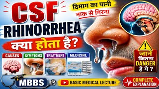 CSF Rhinorrhea /  Causes / Symptoms & BestTreatment हिंदी / Basic Medical Lecture /Neurosurgeon