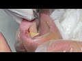 Nice skill sharing for ingrown nail repair