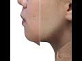 Kybella Injection