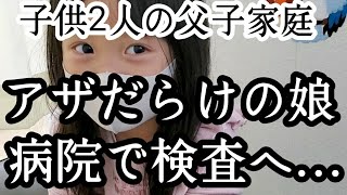 シングルファザー増えていく娘のアザ病院での検査結果…痛みのない複数のアザに不安な気持ち子供2人と父のリアルな現状生活【父子家庭】【新人シングルファザー】【子育て奮闘記】【ルーティン】【VLOG】