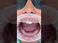 Composite bonding in action  cosmeticdentistry ru.ental