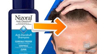 Should you use Ketoconazole Shampoo for Hair Loss!? (Featuring Steve Cook) Net Worth