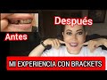 🛑Todo sobre mis BRACKETS/braces/frenos