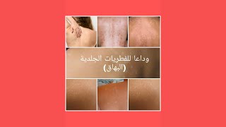 وصفة لعلاج الفطريات الجلدية ( البهاق )