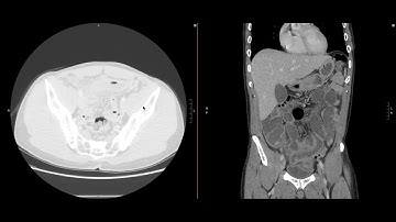 Abdominal Imaging Call Prep Cases: Perforated Appendicitis (CT) Case 2 Discussion