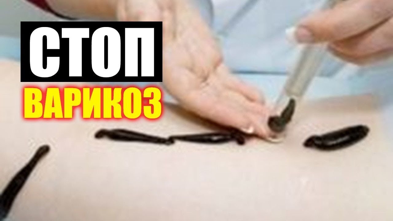 Варикоз На Яичках У Мужчин. Чем Грозит Варикоз Яичка У Мужчин - YouTube