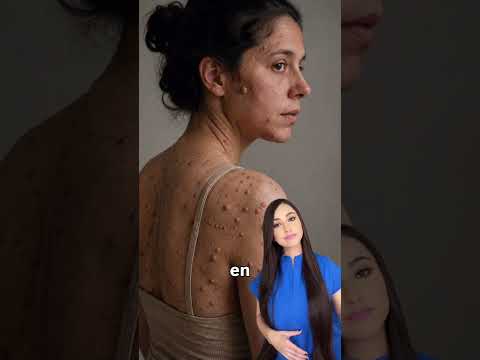 ¿Qué es la neurofibromatosis? 🤔 #neurofibromatosis #tumores #salud #medicina #drapauzúñiga