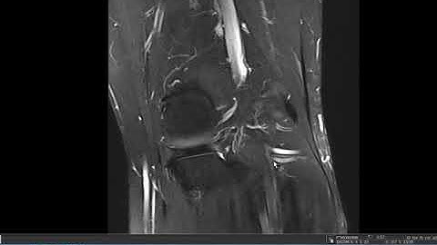 MRI KNEE TUTORIAL