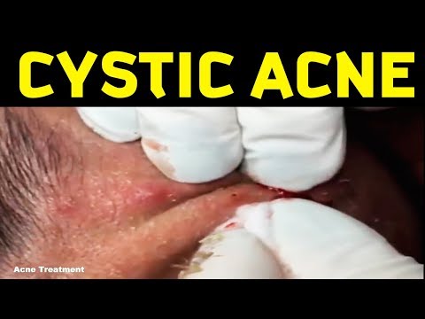 TREATMENT  cystic acne extraction!!