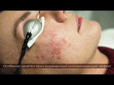Лазерная шлифовка кожи