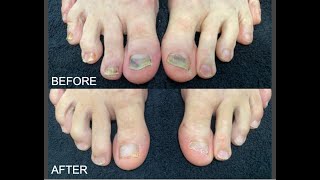 Laser Cured Fungal Nails in Seasoned Athlete