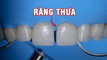 Trám thẩm mỹ răng cửa thưa bằng Composite - Nha Khoa LINH XUÂN