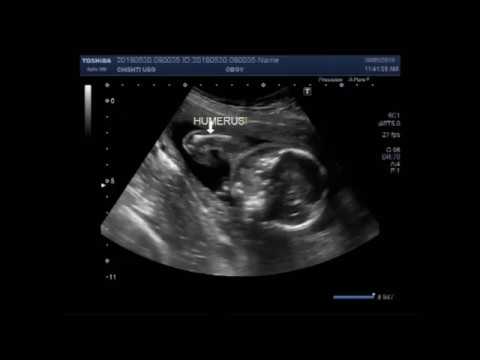 Ultrasound Video Showing A Case Of Club Foot Also Called Talipes Equinovarus Tev Youtube