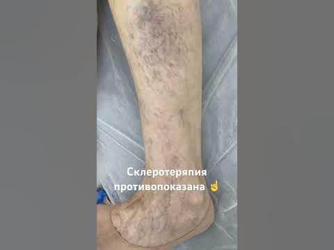 Сосудистая сетка. Склеротерапия противопоказана. Варикоза нет. Флеболог ...