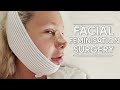 I had Facial Feminisation Surgery (with Facialteam)