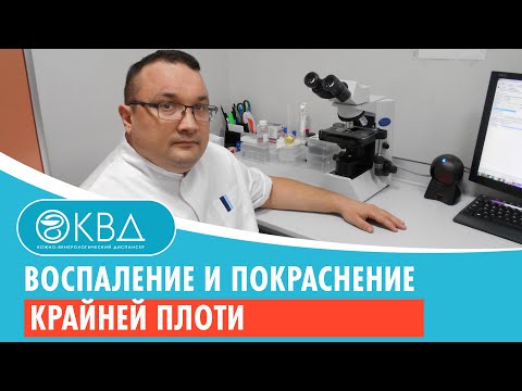 Воспаление и покраснение крайней плоти Клинический случай 678 