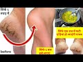               cracked heels remedies at home