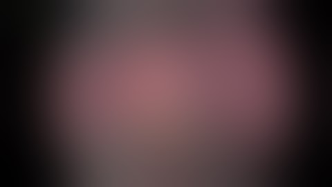 Kiến thức nâng ngực|Nâng ngực nội soi đường nách cho "mẹ bỉm" 1 con