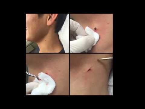 Part II: Pimple Popathon. Blackheads & Whiteheads Unlimited
