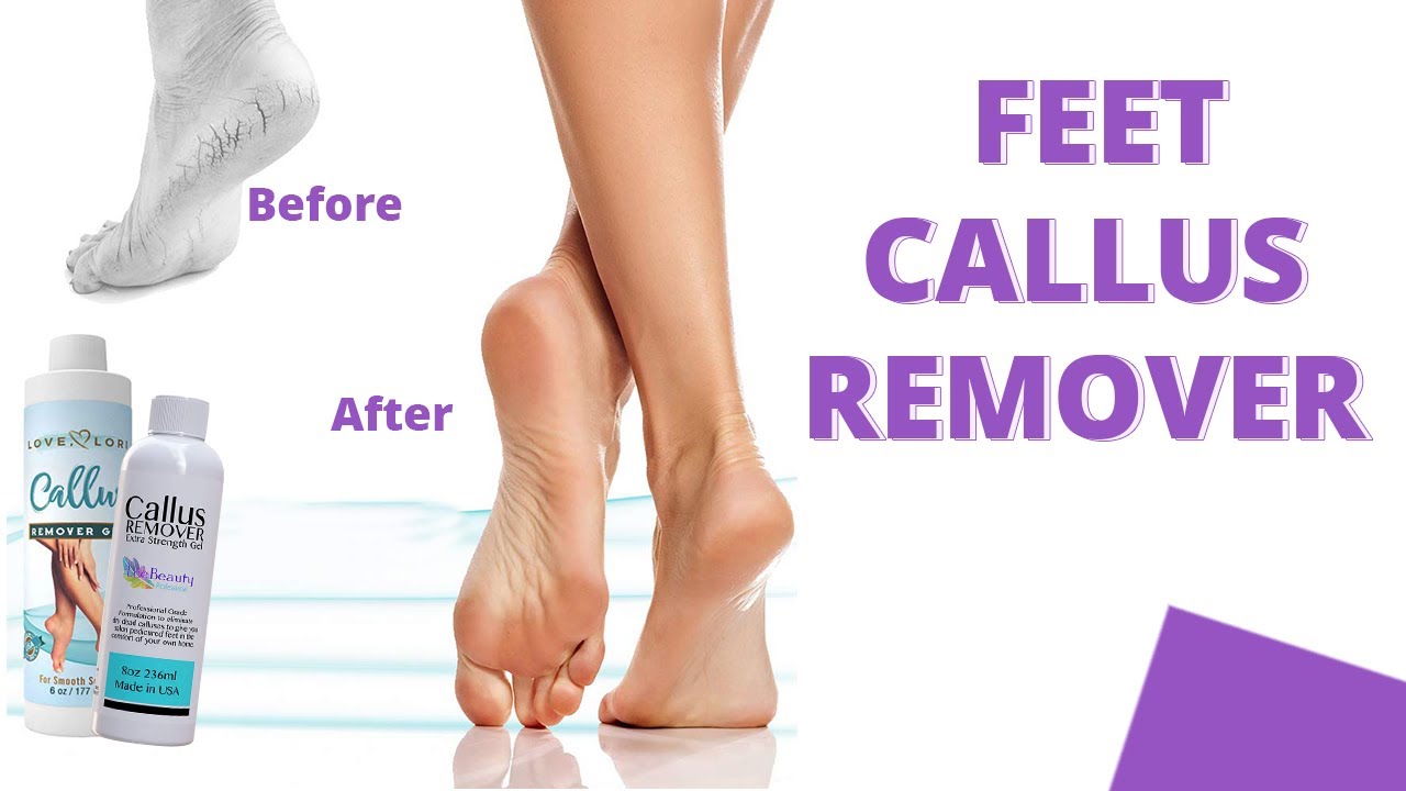 Best Callus Remover, Callus Eliminator, Liquid & Gel for Corn and Callus on Feet