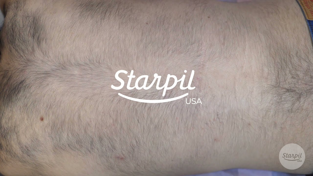 How to Wax Mens Back Hair   Full Back Hair Removal   Starpil Wax
