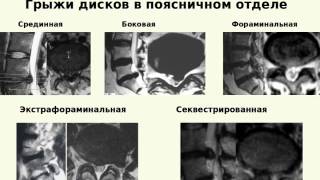 Современные принципы хирургического лечения дегенеративных поражений позвоночника.