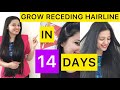 How to Grow Receding Hairline Naturally in 14 Days ||  Hairline को कैसे ठीक करें || Stop Hair fall