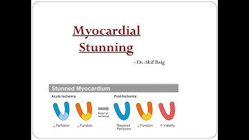 Myocardial stunning: Dr. Akif Baig