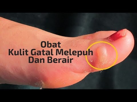 Obat Kulit Gatal Melepuh Dan Berair