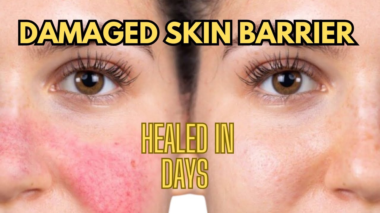 FIX Your Damaged Skin Barrier In 1 week | How to heal skin barrier