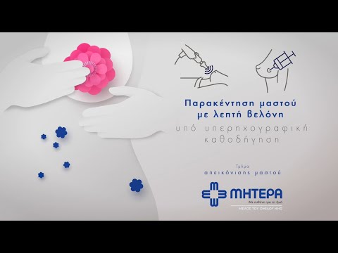 Παρακέντηση μαστού με