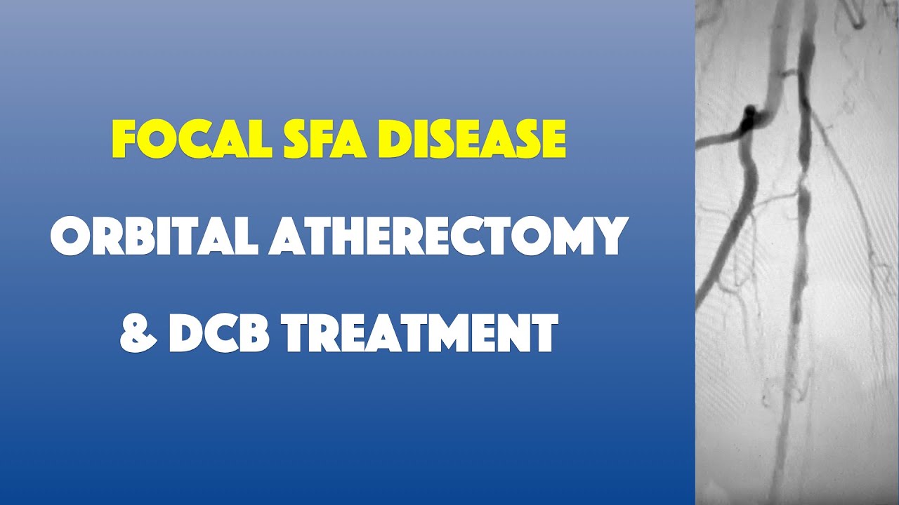 Focal SFA Disease Treated with Orbital Atherectomy and DCB YouTube