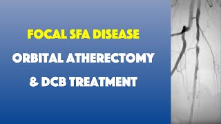 Focal SFA Disease Treated with Orbital Atherectomy and DCB