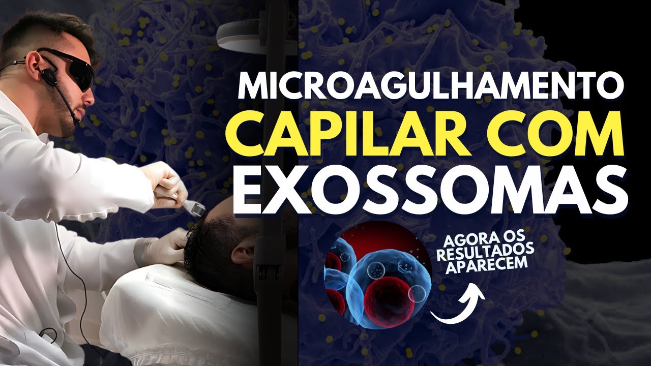 Microagulhamento CAPILAR com EXOSSOMAS | Aula prática