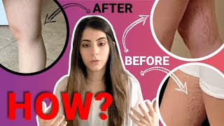 Did I get rid of my STRETCH MARKS? | ¿Elimine mis estrías? | #StoryTime | Mi mayor COMPLEJO | HOW? by VeroTime 51,390 views 4 years ago 9 minutes, 26 seconds