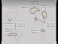 Types of Epiphysis
