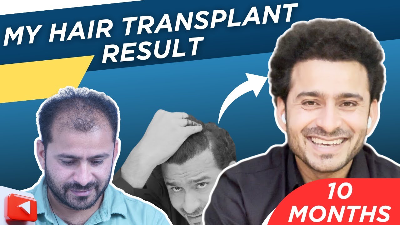 Hair Transplant in Pune || 10 Months Result - Hairmate Clinic Pune || Hair transplant best result
