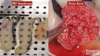 Platelet Rich Fibrin (PRF) Preparation for Membrane and Sticky Bone for Grafting screenshot 1