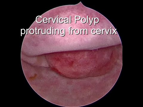 Video: Cervikal Polyp: Symptomer Og Behandling, Foto, Kirurgi For At Fjerne