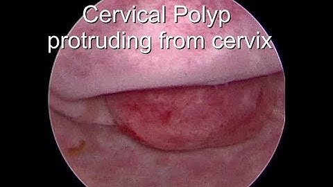 Hysteroscopic Resection of Recurrent Cervical Polyp By Dr.Pragnesh Shah M.D. F.I.C.O.G.