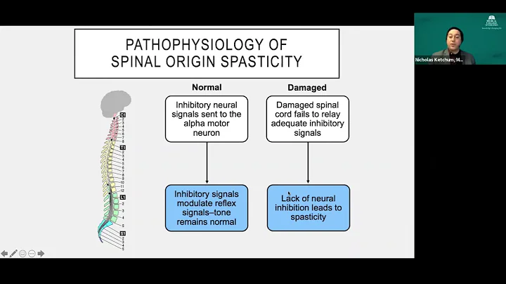Dr. Nicholas Ketchum talks about intrathecal Baclo...
