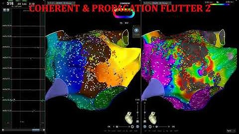 AF & DOUBLE ATYPICAL FLUTTER ABLATION!