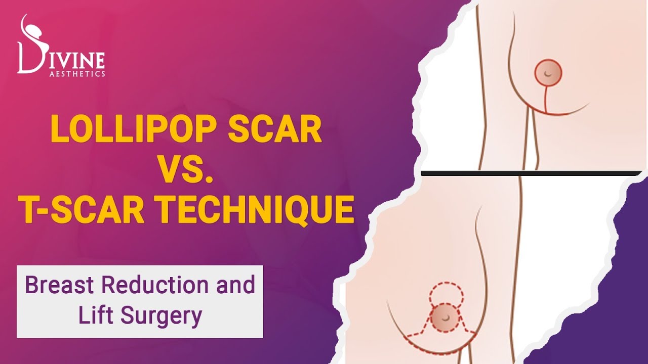 Lollipop Incision Breast Reduction & Lift Surgery: Lollipop Scar Vs. T-scar Technique ...