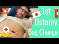 🏠Home Health Ostomy Bag💩 - Changing and Learning📚