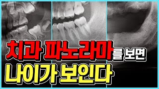 얼굴은 20대! 치아나이는 50대?! 신체나이는 속여도 치아나이는 못 속이는 파노라마 보는법!